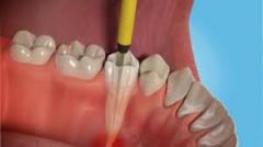 Root Canal Treatment At Simply Teeth Essex