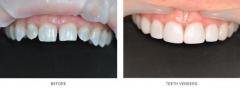 Contact Simply Teeth Essex For Dental Veneers Tr