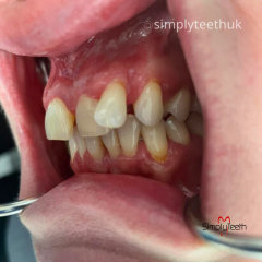 Invisalign  6 Month Smiles Treatment From Simply