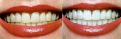 Affordable Teeth Whitening Treatments In Uk - Co