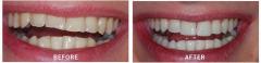 Effective Composite Tooth Filling Treatment In U