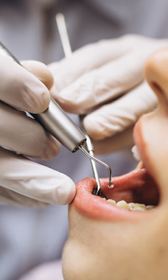 Affordable Dental Extractions Treatment In Uk