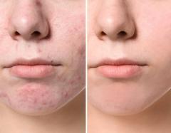 Its Time To Get The Best Acne Scar Treatment By 