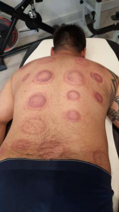 Hijama Cupping Training In London