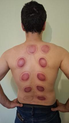 Healing Through Hijama Cupping Therapy Training