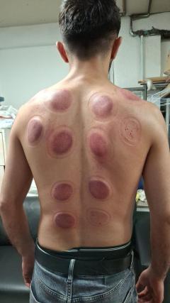 Hijama Cupping Therapy Course In London  Accredi