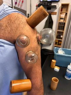 Hijama Wet Cupping, Fire Cupping, Dry Cupping Al