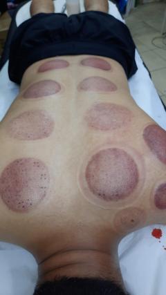 Professional Hijama Cupping Therapy In London  A