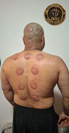 Hijama Cupping Course In London