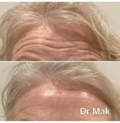 Reduce Wrinkles On Your Face By Anti-Wrinkle Inj