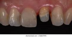 Are You In Search Of Dental Crowns Treatment In 