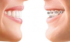 Call Us Today For Effective Teeth Straightening 