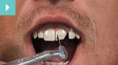 Dental Crown Treatments In Twickenham - Eye Smil