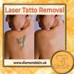 Tattoo Removal London - Diamond Skin Aesthetic A