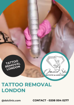 Tattoo Removal London