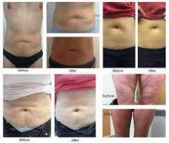 Non-Surgical Lipo Fat Reduction Treatment From S