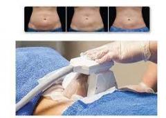 Cryo Fat Freeze Treatment From Sarah M Laser And