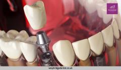 Dental Bonding Procedure And Cost In The Uk