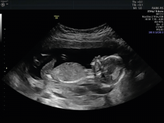 Unveil The Excitement With Baby Gender Scan In A