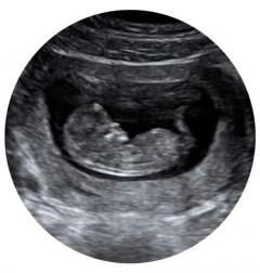 Fetal Well-Being Ultrasound In Aylesbury