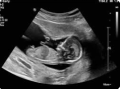 Experience The Best Ultrasound Baby Scan In Hitc