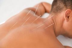 Experience The Healing Power Of Acupuncture In C