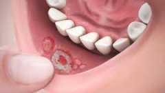 Sore Mouth Woes Understanding How Long Canker So
