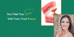 Dont Hide Your Smile With Train-Track Braces