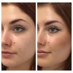 North East Glow-Up Dermal Fillers Unveiled