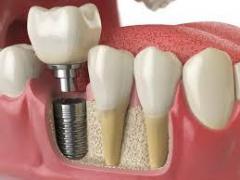 Get The Perfect Smile With Dental Implants In Lo