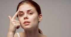 Say Goodbye To Acne With Natural Treatments In M