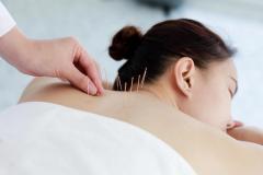 Professional Acupuncture Treatment London Restor