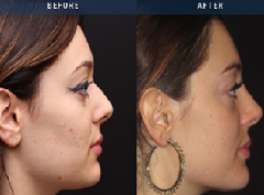 Best Rhinoplasty Surgeon In Ealing - Bmacs Clini