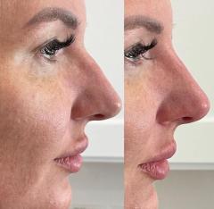 Best Rhinoplasty Surgeon In Slough - Call 020363