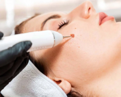 Skin Cancer Screening Maidenhead - Call 02036330