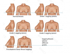 Breast Lift With Suture Suspension Ealing & Wind