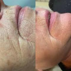 Microneedling - Rejuvenate Your Skin And Boost C