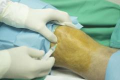 Expert Knee Surgeon In Warrington
