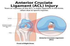 Acl Injury Treatment By Specialist Knee Surgeon
