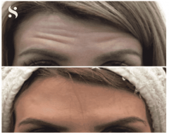 Smooth Away Wrinkles With Expert Botox In Leeds 