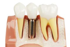 Affordable Dental Implants Options in Camden NW1