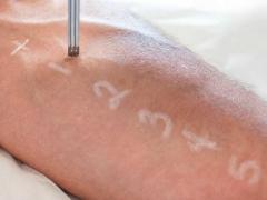 Skin Allergy Testing At Medical Express Clinic I