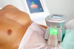 Achieve a Perfect Figure with Cryolipolysis