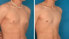 Gyno Treatment - Uk Gynecomastia Clinics