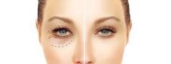 For Lower Eyelid Blepharoplasty Consult Dr Pari 