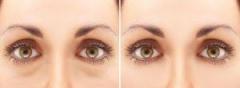 Do You Have Symptoms Of Blepharoplasty Then Cont