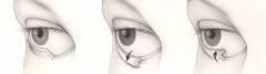 Entropion Repair  Functional Eyelid Surgery In L