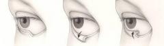 Ectropion Repair, Best Eyelid Surgery In Uk