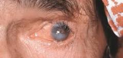 Abnormal Eyelashes Trichiasis Causes, Symptoms, 